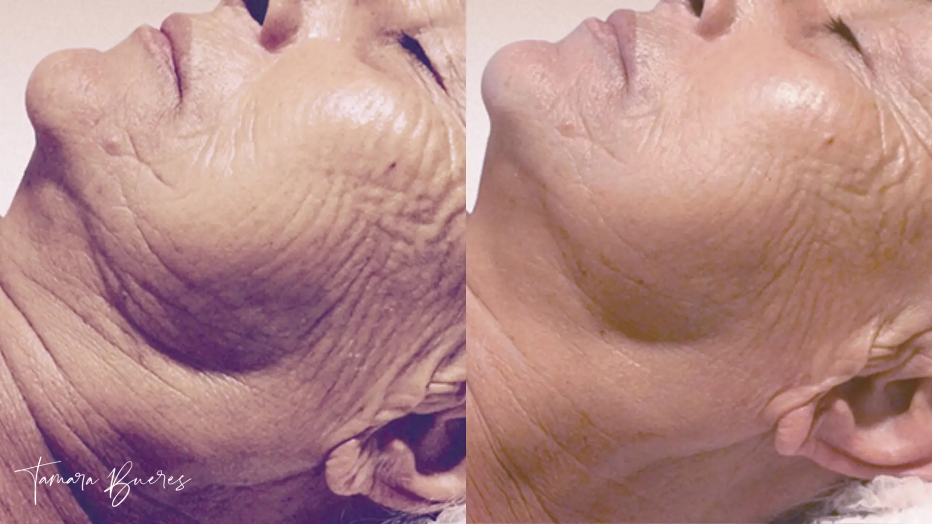 antes y después de un tratamiento de radiofrecuencia indiba en el centro de estética en Llanes