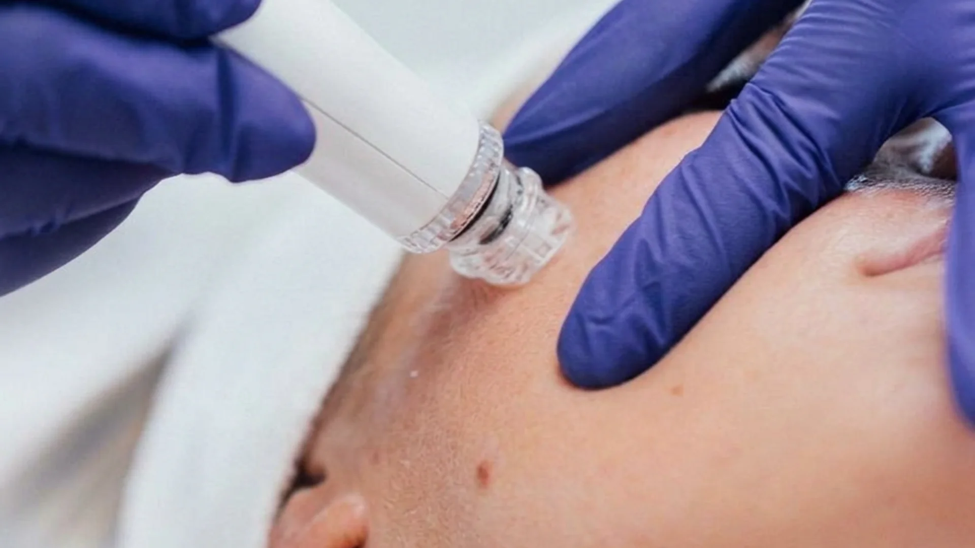 Detalle del cabezal Cleansing de INDIBA ONA durante la hidrodermoabrasión facial en Centro de Estética Tamara, Llanes