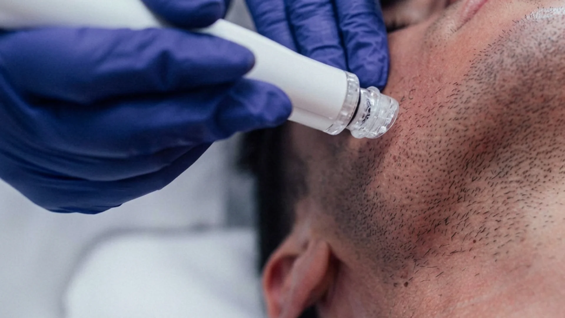 Aplicación de INDIBA ONA con cabezal de hidrodermoabrasión en la mandíbula en Centro de Estética Tamara, Llanes